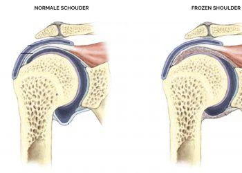 Herken een frozen shoulder!