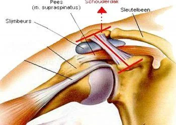 Impingement Syndroom meest gestelde diagnose bij schouderklachten
